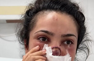 گاز گرفتن بینی زن توسط شوهر مست؛ پایان تلخ یک درگیری خانوادگی+فیلم