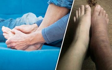 تورم مچ پا نشانه‌ای هشدار دهنده از وجود این بیماری
