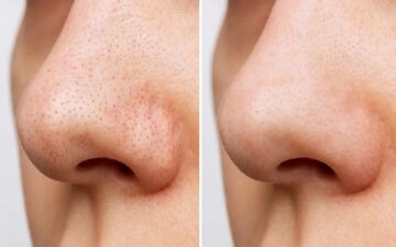 جوش سرسیاه داری؟ اینجا رو بخون تا یاد بگیری چطوری از شرش خلاص شی!