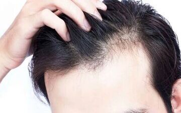 مهمترین دلایل ریزش موهای سر

