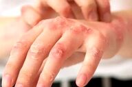 چگونه با تغییرات کوچک، از شر اگزمای دست خلاص شویم؟