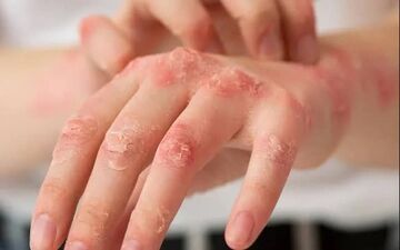 چگونه با تغییرات کوچک، از شر اگزمای دست خلاص شویم؟