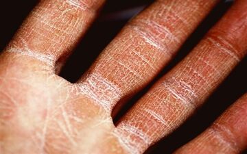 تغییرات اقلیمی، دشمن اگزما؛ آلودگی هوا و دماهای شدید بیماری پوستی را تشدید می‌کنند
