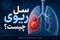 خطر بازگشت یک قاتل باستانی؛ از سرفه‌های ۳ هفته‌ای تا تعریق شبانه و خلط خونی با بیماری سل!