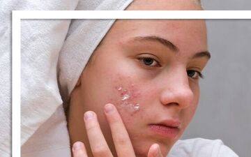 چند ماده غذایی که اکنه را فعال می‌کند