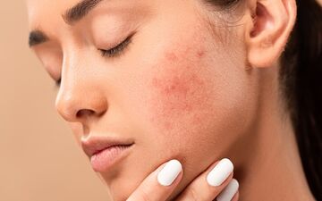 آیا جوش‌ صورت واگیردار است؟