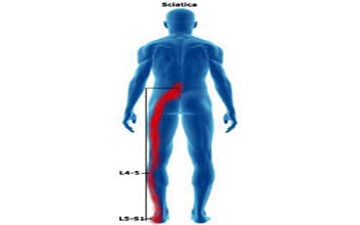 سیاتیک اذیتت میکنه؟ بیا تا درمان سه سوته را نشونت بدم!