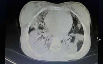 نجات جان مادر باردار با 80 درصد درگیری ریه در زنجان/ بیمار واکسن کرونا تزریق نکرده است
