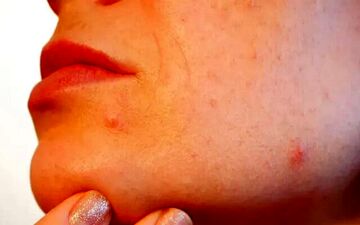 راهی برای خلاصی از شر آکنه‌ها