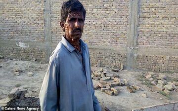 بیماری وحشتناک مرد جوان پاکستانی سوژه رسانه ها شد+ فیلم 