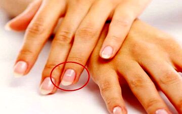  علت لکه های سفید روی ناخن ها چیست؟