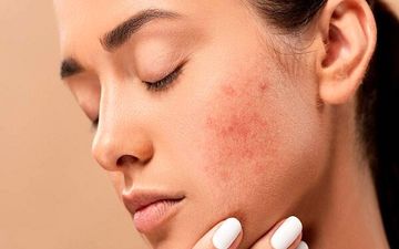 ۶ دلیل که جوش زدن در بزرگسالی هم رهایتان نمی‌کند
