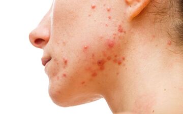 التهاب پوستی ناشی از استرس