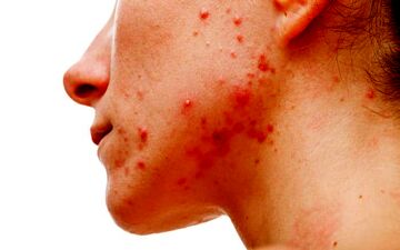 التهاب پوستی ناشی از استرس