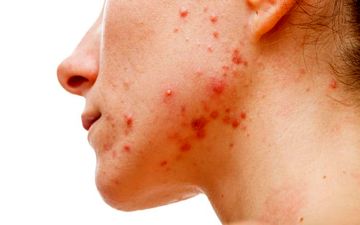 التهاب پوستی ناشی از استرس