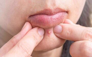 برای اینکه جوش نزنیم چه بخوریم؟