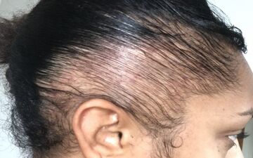 پیشگیری از ریزش مو کششی