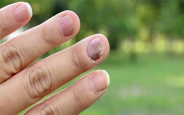 احتمال بروز قارچ در ناخن های کاشت شده