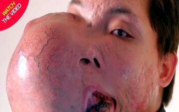 تغییر شکل عجیب صورت مرد جوان در اثر تومور وحشتناک! +فیلم 