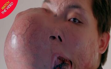 تغییر شکل عجیب صورت مرد جوان در اثر تومور وحشتناک! +فیلم 