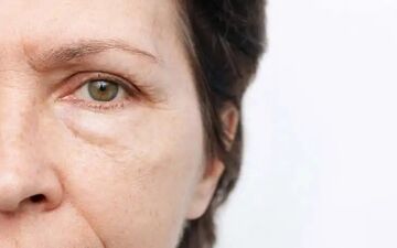 چرا صبح‌ها صورتمان پف می‌کند؟ دلایل علمی و راهکارهای کاهش التهاب صبحگاهی
