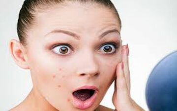 جوش‌های صورت ناشی از مصرف آجیل را با این خوراکی خنثی کنید 