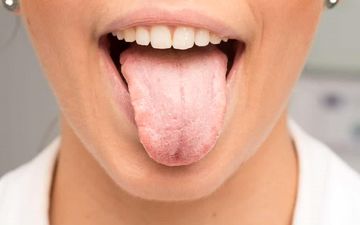 علائم خشکی دهان چیست؟عوارض آن را بدانید!