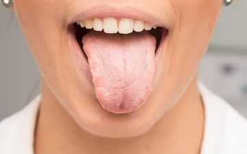 علائم خشکی دهان چیست؟عوارض آن را بدانید!