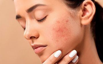 خودارضایی باعث آکنه می شود؟