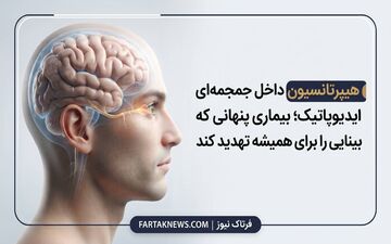 هیپرتانسیون داخل جمجمه‌ای ایدیوپاتیک؛ بیماری پنهانی که می‌تواند بینایی را برای همیشه تهدید کند