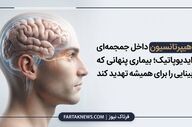 هیپرتانسیون داخل جمجمه‌ای ایدیوپاتیک؛ بیماری پنهانی که می‌تواند بینایی را برای همیشه تهدید کند