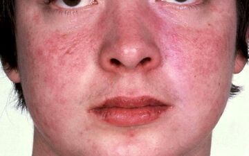 آلرژی به سیر چه علائمی دارد؟