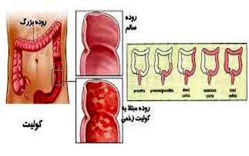 همه چیز درباره کولیت روده 