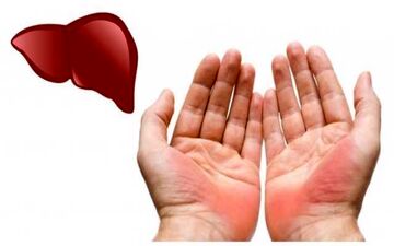تغییرات کف دست نشانه چه بیماری است؟

