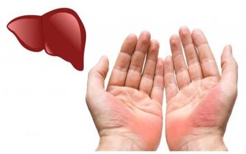 تغییرات کف دست نشانه چه بیماری است؟

