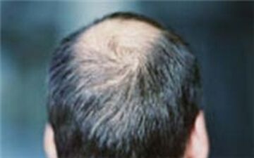 کاهش سن ریزش مو/ دلایلی که سبب کچلی می‌شود