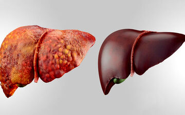 علائم کبد چرب چیست؟ 