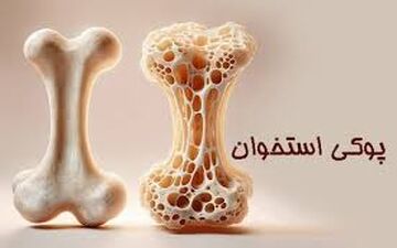 علائم اولیه پوکی استخوان‌