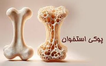 علائم اولیه پوکی استخوان‌