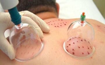 بهترین موقع برای «حجامت» دقیقا چه زمانی است؟