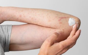 تشخیص اشتباه و مصرف پماد کورتونی، عامل گسترش قارچ پوستی