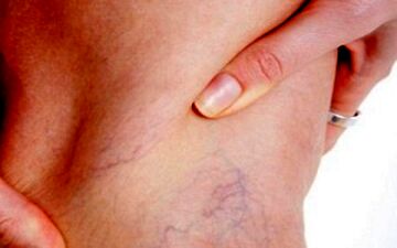 5 راهکار طلایی برای درمان دردهای واریس