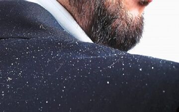 آشنایی با عوامل اصلی شوره سر