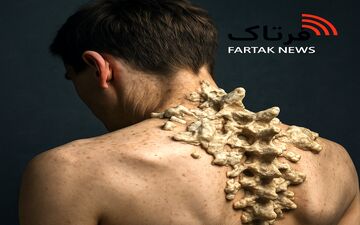 بیماری مرد سنگی؛ وقتی بدن خودش را به قفس تبدیل می‌کند