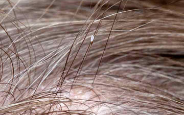 درباره شپش چه می‌دانید؟