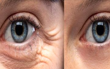 چطور چین‌وچروک‌های گوشه چشم را برطرف کنیم؟

