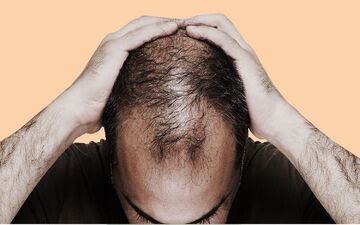 چگونه استرس فولیکول‌های مو را به یک هدف ایمنی تبدیل می‌کند؟