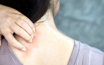 راهکارهایی برای پیشگیری از عرق‌سوز شدن