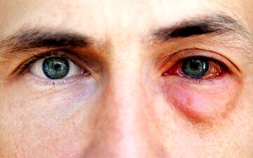 بررسی ماجرای شیوع کرونای چشمی در کشور 