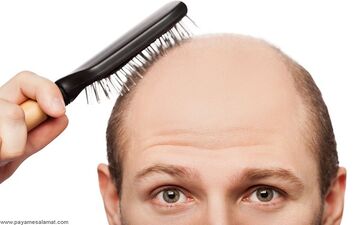 ریزش مو دارید و از طاس شدن می ترسید؟ بخوانید 